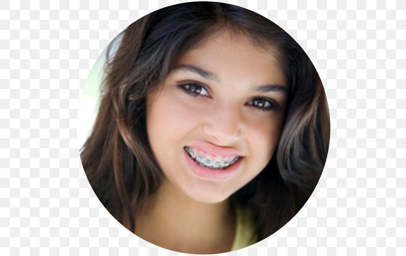 Orthodontics Dental Braces Dentistry Tooth, PNG, 518x518px, Orthodontics, Adolescence, American Board Of Orthodontics, Beauty, Black Hair Download Free