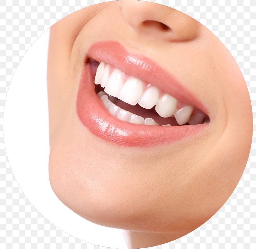 Tooth Whitening Dentistry Human Tooth, PNG, 800x800px, Tooth Whitening, Bridge, Cheek, Chin, Close Up Download Free
