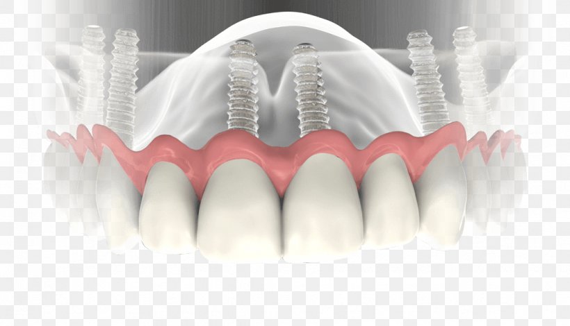 Dental Implant Dentistry Dentures, PNG, 1072x615px, Watercolor, Cartoon, Flower, Frame, Heart Download Free