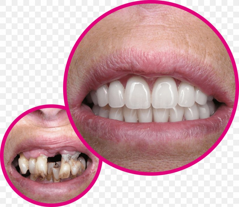 Tooth Bridge Crown Dentist Veneer, PNG, 1024x888px, Tooth, Bridge, Crown, Dental Implant, Dental Laboratory Download Free