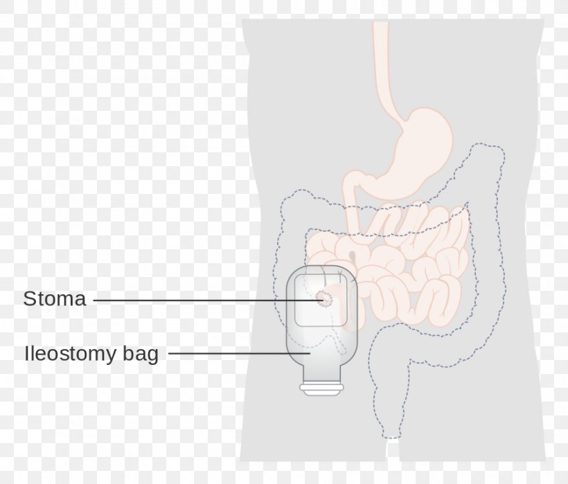 Ileostomy Abdomen Hip Shoulder Thumb, PNG, 900x768px, Watercolor, Cartoon, Flower, Frame, Heart Download Free