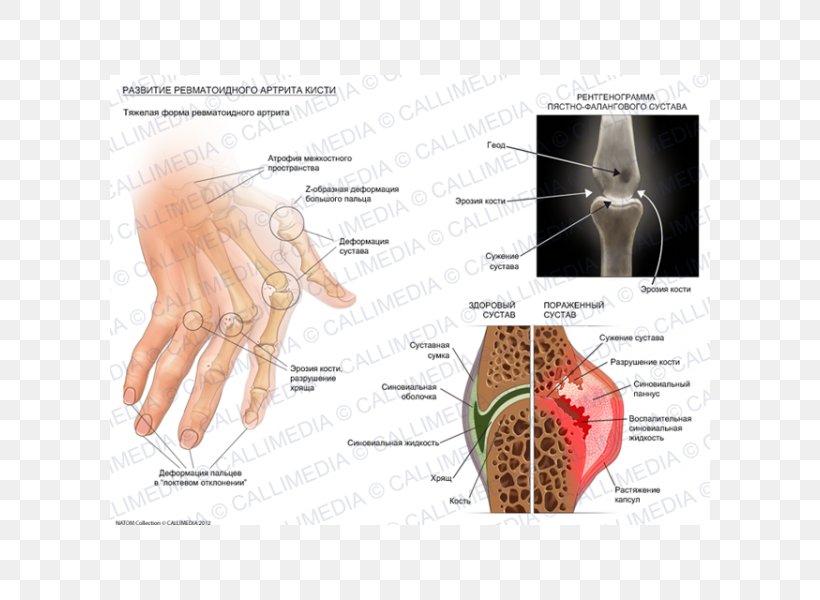 Rheumatoid Arthritis Chronic Childhood Arthritis Disease Rheumatism, PNG, 600x600px, Watercolor, Cartoon, Flower, Frame, Heart Download Free