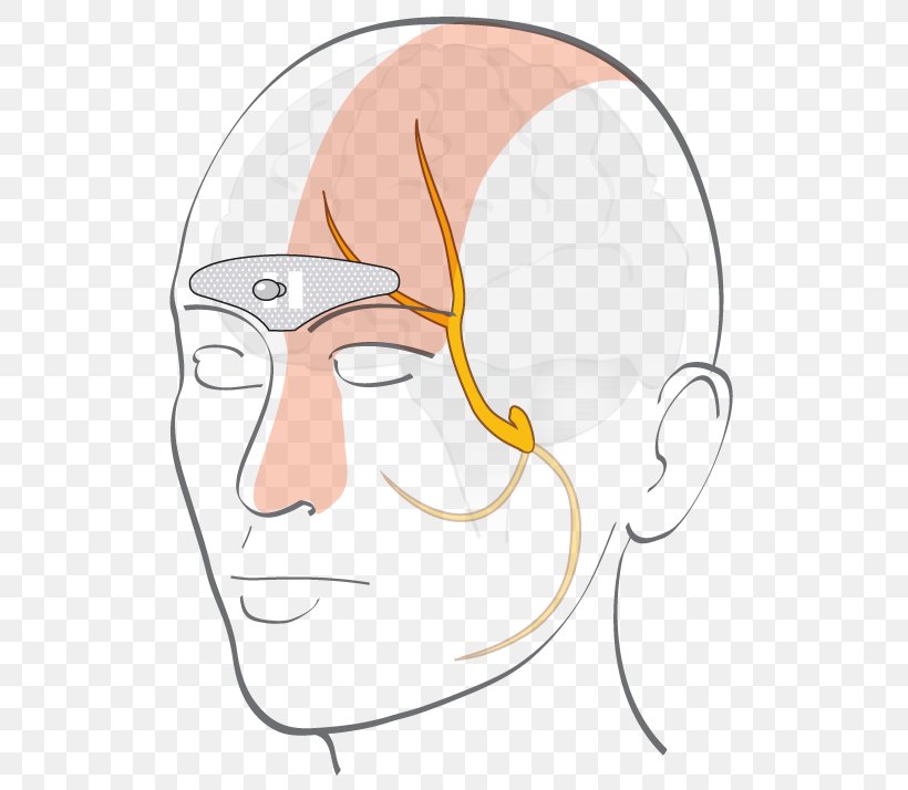 Ear Forehead Cefaly Electrode Migraine, PNG, 600x714px, Watercolor, Cartoon, Flower, Frame, Heart Download Free