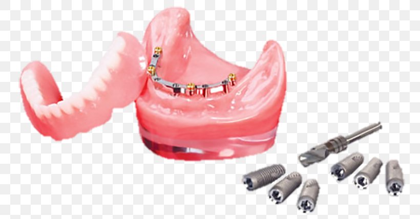 Utica Plastic Dental Laboratory, PNG, 810x428px, Utica, Dental Consonant, Dental Laboratory, Jaw, Patient Download Free