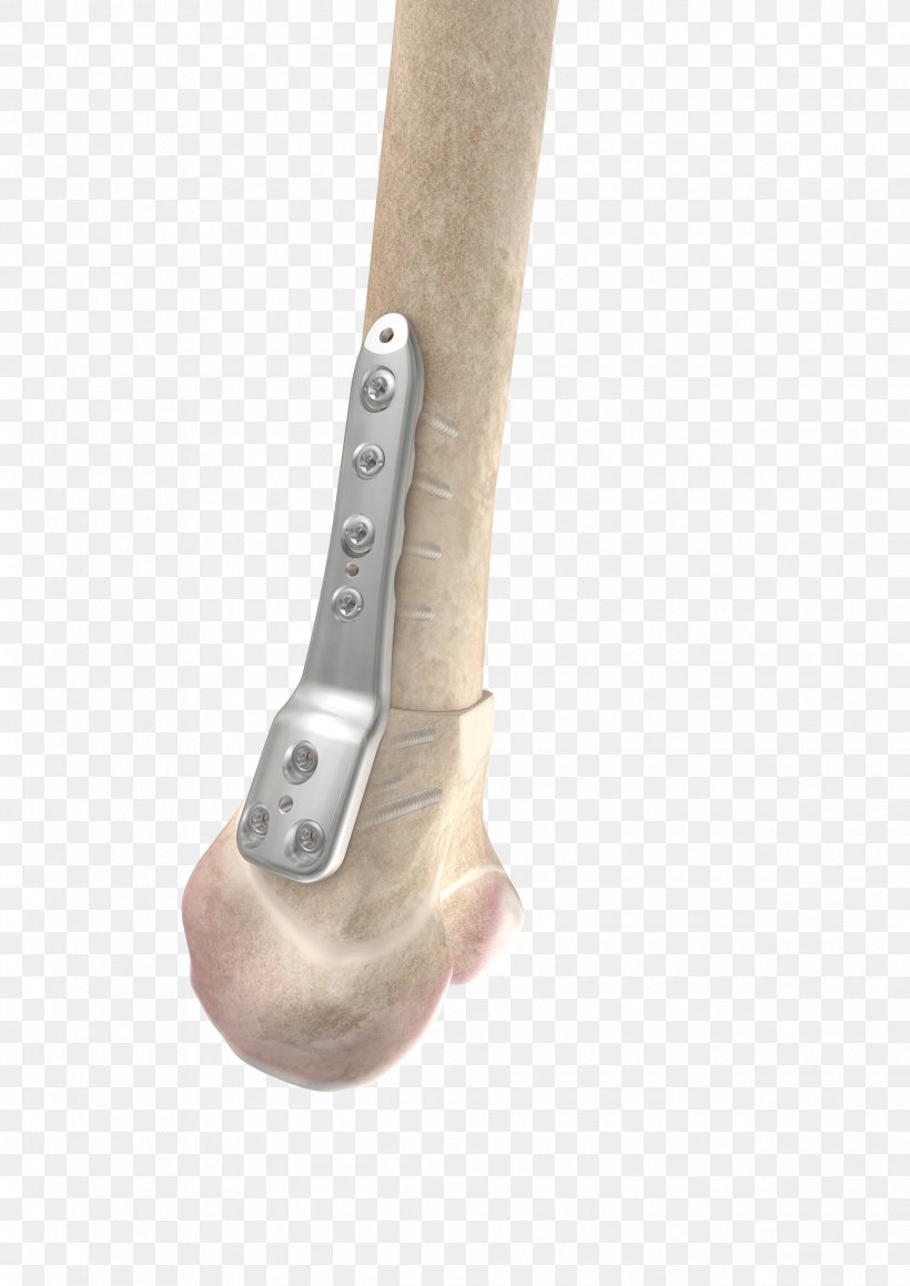 Osteotomy Distal Joint Knee Tibia, PNG, 2480x3508px, Osteotomy, Bone Fracture, Dental Implant, Distal, Femur Download Free