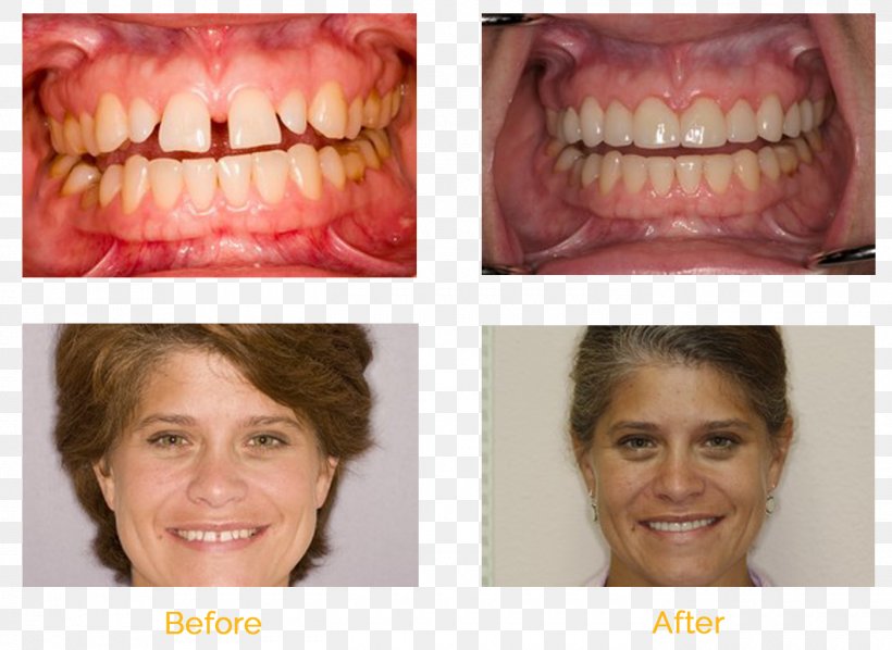 Universal Smiles Dentistry, PNG, 1400x1021px, Dentistry, Cheek, Chin, Close Up, Cosmetic Dentistry Download Free