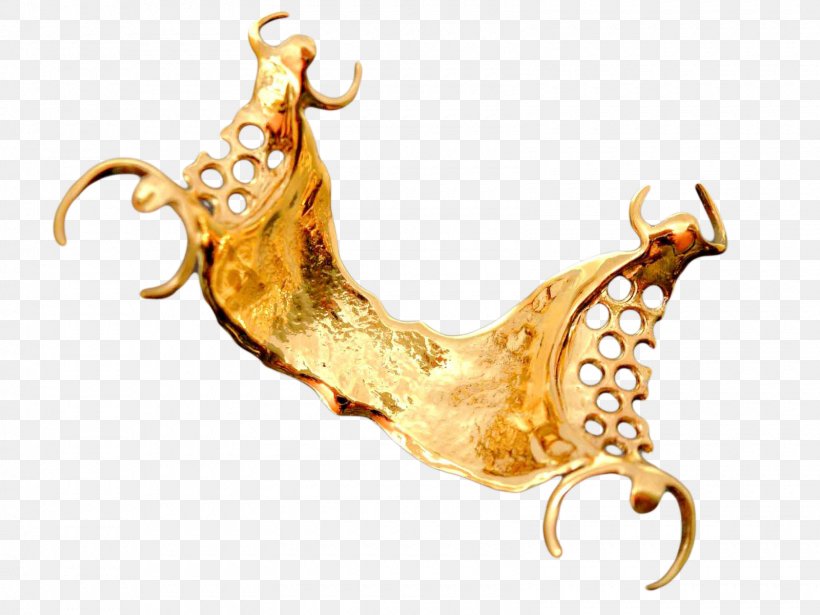 Gold Removable Partial Denture Dentures Crown Dentistry, PNG, 1600x1200px, Gold, Biocompatibility, Body Jewelry, Crown, Dental Laboratory Download Free