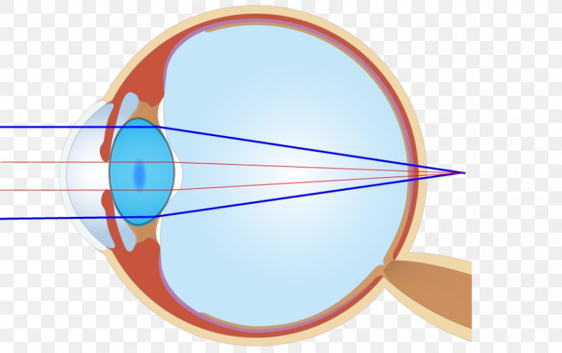 Eye 後遺障害 Ophthalmology Medical Device Contact Lenses, PNG, 860x542px, Eye, Contact Lenses, Disability, Eyelid, Field Of View Download Free