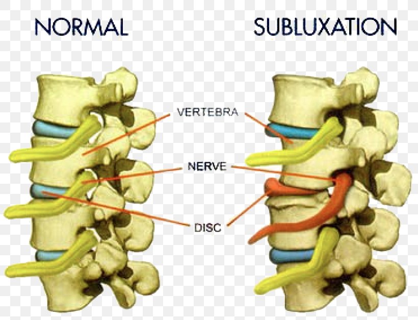 Vertebral Subluxation Chiropractic Vertebral Column Pain, PNG, 807x627px, Vertebral Subluxation, Bone, Chiropractic, Chiropractor, Disease Download Free