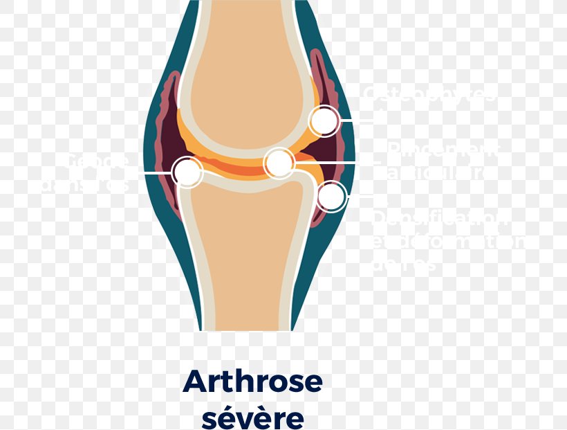 Knee Osteoarthritis Knee Osteoarthritis Hip Shoulder, PNG, 705x621px, Osteoarthritis, European League Against Rheumatism, Hip, Human Leg, Joint Download Free
