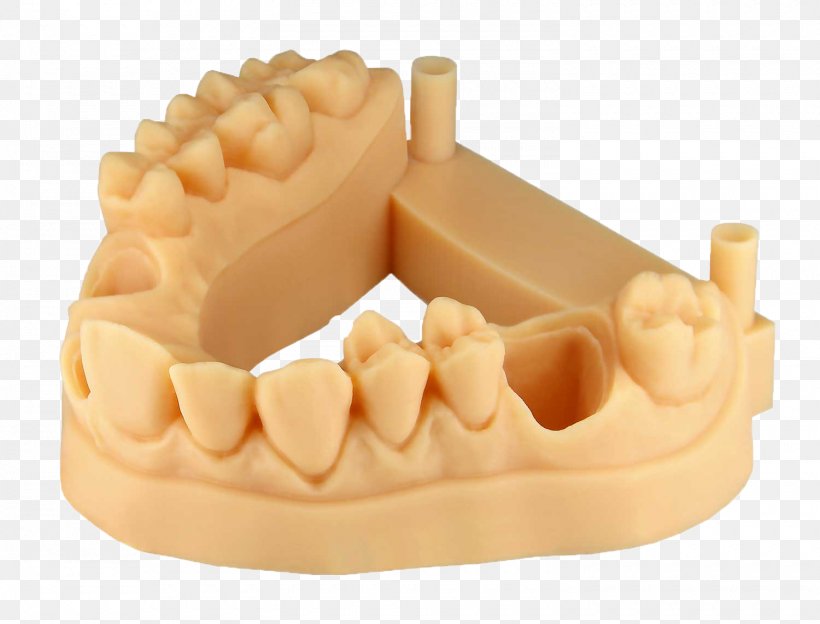 Tooth 3D Printing EnvisionTEC Crown Fabrication Additive, Impression 3D., PNG, 1500x1143px, 3d Printing, Tooth, Bridge, Crown, Dental Implant Download Free