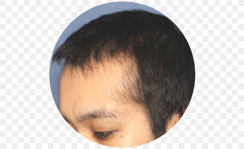 Forehead Management Of Hair Loss Capelli Eyebrow, PNG, 500x500px, Forehead, Black Hair, Capelli, Chin, Ear Download Free