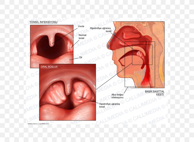 Tonsillitis Pharyngitis Otorhinolaryngology Adenoid, PNG, 600x600px, Watercolor, Cartoon, Flower, Frame, Heart Download Free