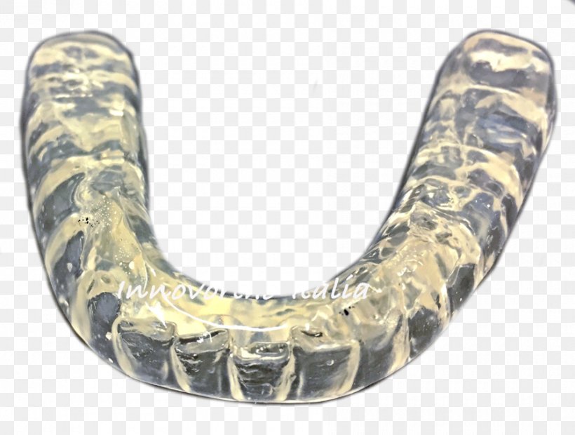 Occlusal Splint Bruxism Temporomandibular Joint Jaw Orthodontics, PNG, 900x681px, Occlusal Splint, Alaleuanluu, Bruxism, Dentistry, Innovorthoitalia Download Free
