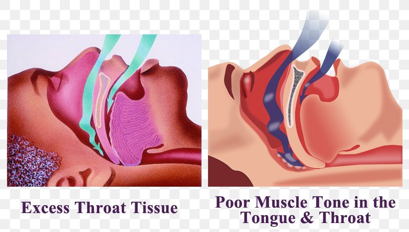 Snoring Obstructive Sleep Apnea Throat, PNG, 809x466px, Watercolor, Cartoon, Flower, Frame, Heart Download Free