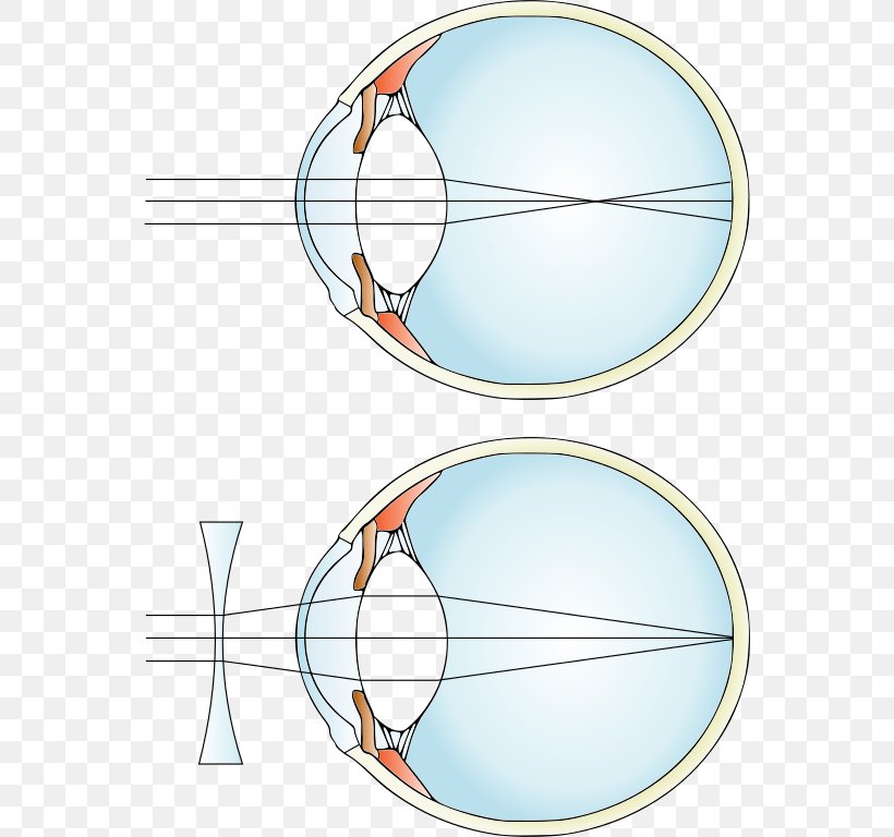 Near-sightedness Hypermetropia Corrective Lens Refractive Error, PNG, 556x768px, Nearsightedness, Area, Astigmatism, Contact Lenses, Corrective Lens Download Free