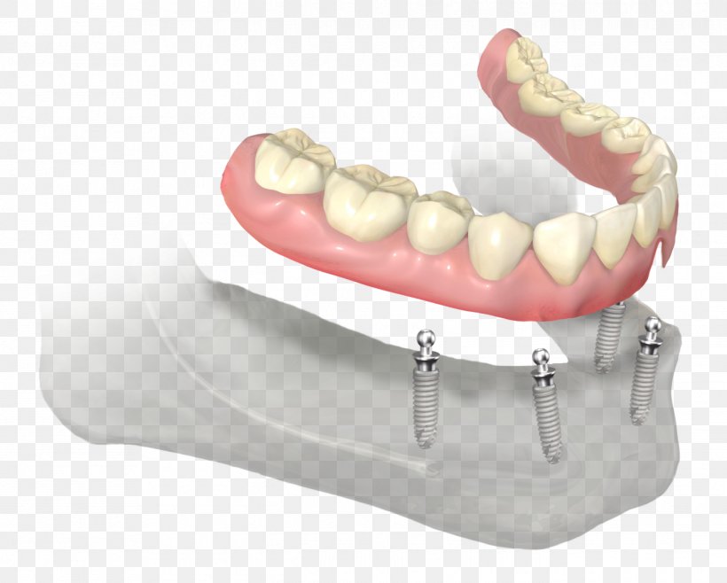 Dentures Dentistry Dental Implant Abutment Prosthesis, PNG, 1345x1080px, Dentures, Abutment, Bad Breath, Clinic, Dental Implant Download Free