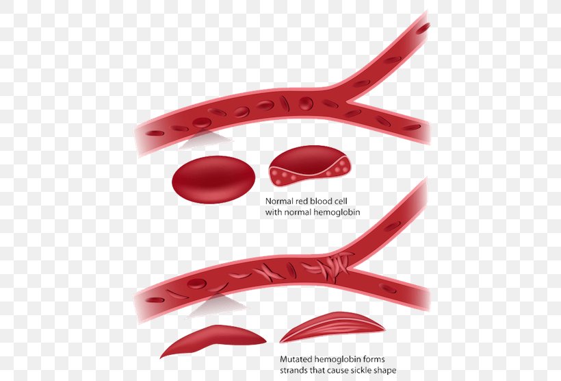 Sickle Cell Disease Red Blood Cell Anemia, PNG, 500x556px, Sickle Cell Disease, Anemia, Blood, Blood Cell, Cancer Download Free