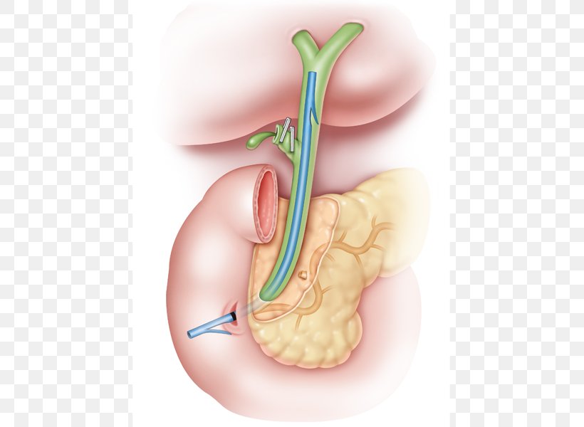 Stenting Common Bile Duct Gallbladder, PNG, 600x600px, Watercolor, Cartoon, Flower, Frame, Heart Download Free