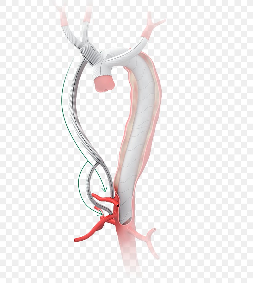 Surgery Graft Aorta Aortic Dissection Anastomosis, PNG, 800x916px, Watercolor, Cartoon, Flower, Frame, Heart Download Free