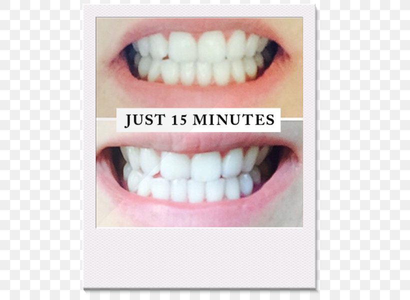 Tooth Whitening Human Tooth Laser, PNG, 600x600px, Tooth Whitening, Bridge, Color, Cosmetic Dentistry, Crown Download Free