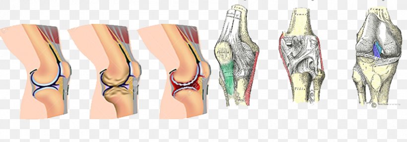 Arthritis Pain Osteoarthritis Rheumatoid Arthritis Joint Pain, PNG, 848x296px, Watercolor, Cartoon, Flower, Frame, Heart Download Free