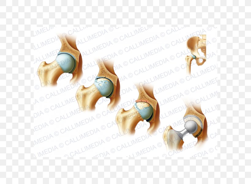 Bone Fracture Cat Arthritis Clavicle Fracture Rheumatology, PNG, 600x600px, Bone Fracture, Anatomy, Arthritis, Body Jewellery, Body Jewelry Download Free