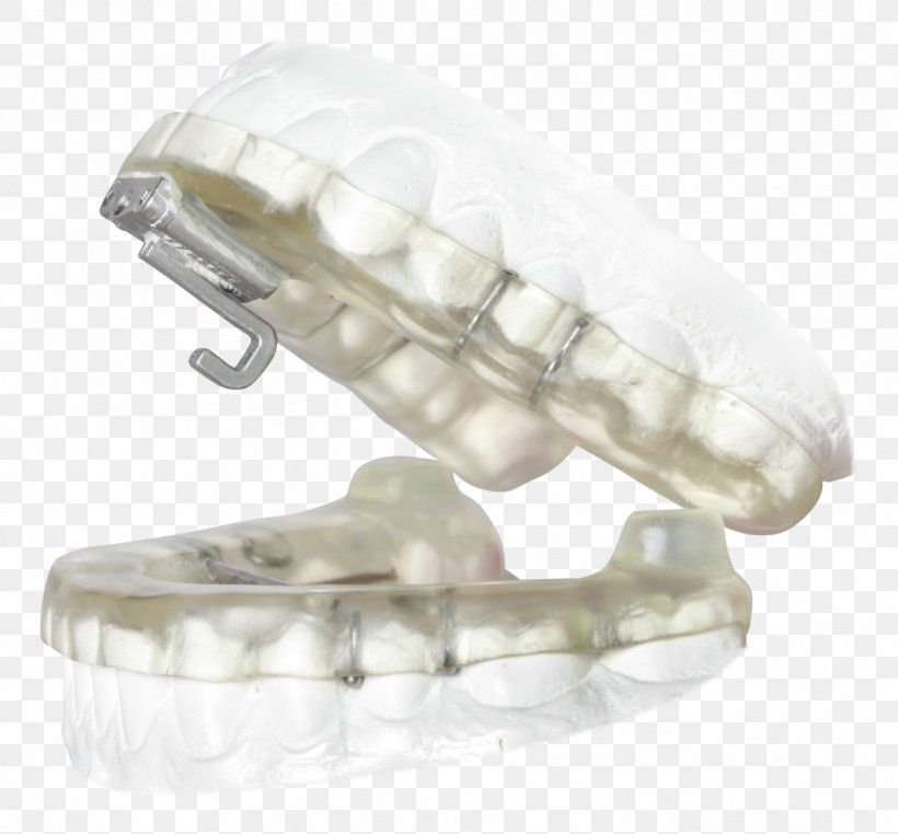 Mandibular Advancement Splint Obstructive Sleep Apnea Temporomandibular Joint Dysfunction, PNG, 1024x952px, Mandibular Advancement Splint, Apnea, Continuous Positive Airway Pressure, Dentistry, Jaw Download Free