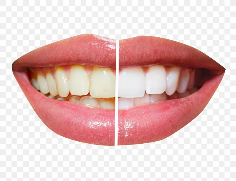 Cosmetic Dentistry Tooth Whitening, PNG, 1822x1400px, Dentistry, Clear Aligners, Cosmetic Dentistry, Crown, Dental Implant Download Free