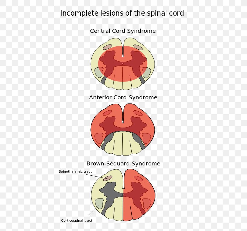 Spinal Cord Injury Anterior Spinal Artery Syndrome Central Cord Syndrome, PNG, 461x768px, Watercolor, Cartoon, Flower, Frame, Heart Download Free