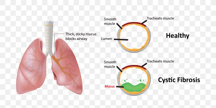 Mucus Blood Hemoptysis Cystic Fibrosis Nose, PNG, 720x410px, Mucus, Bleeding, Blood, Blood Test, Cough Download Free