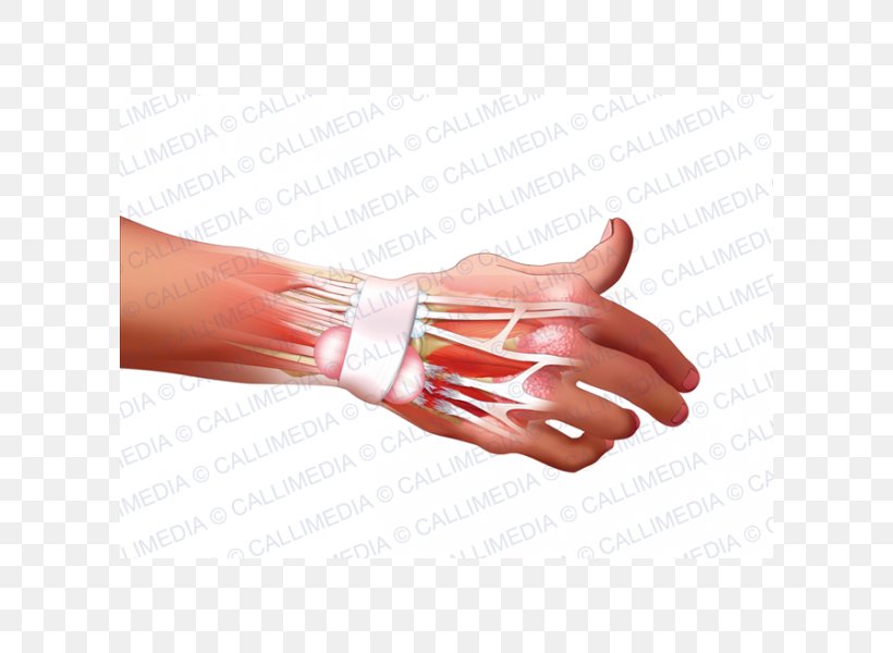 Hand Model Nail Rheumatoid Arthritis Disease, PNG, 600x600px, Hand, Arm, Disease, Finger, Hand Model Download Free