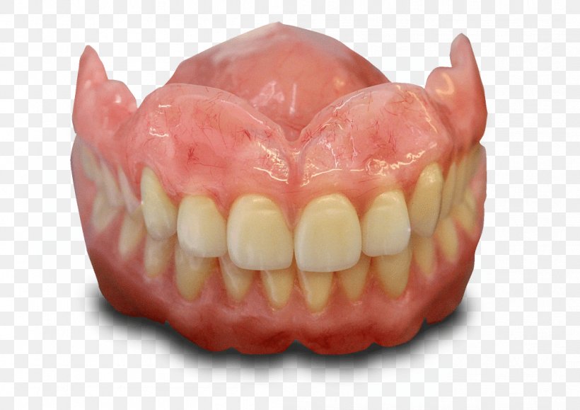 Tooth Dentures Dentistry Dental Implant Dental Laboratory, PNG, 1052x744px, Tooth, Bridge, Cosmetic Dentistry, Crown, Dental Implant Download Free