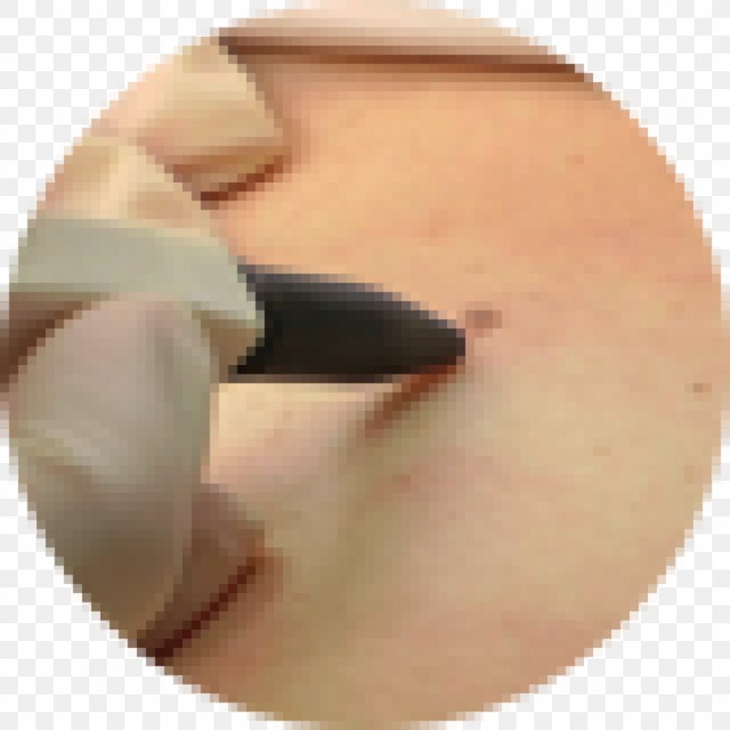 Skin Tag Wart Leicester Laser Clinic LA, PNG, 1024x1024px, Skin Tag, Cheek, Chin, Clinic, Close Up Download Free