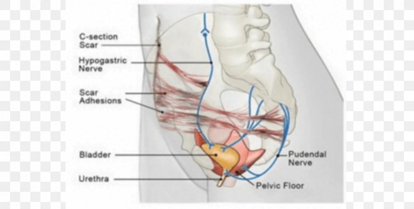 Scar Adhesion Caesarean Section Nerve Surgery, PNG, 990x500px, Watercolor, Cartoon, Flower, Frame, Heart Download Free