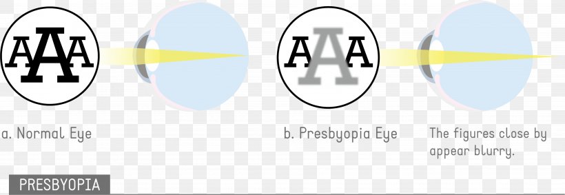 Astigmatism Eye Disease Visual Perception Amblyopia, PNG, 3783x1310px, Astigmatism, Amblyopia, Area, Brand, Diagram Download Free