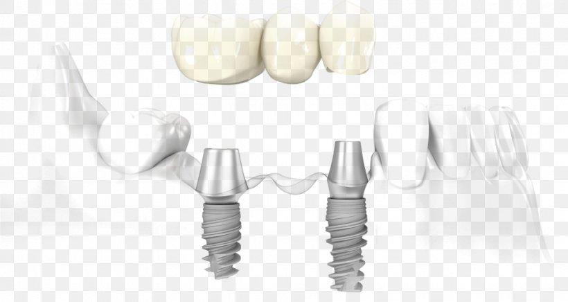 Dental Implant Dentistry Bridge, PNG, 971x517px, Dental Implant, Bridge, Crown, Dentist, Dentistry Download Free