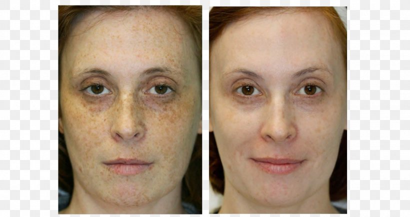 Liver Spot Eyebrow Face Skin Photorejuvenation, PNG, 1920x1018px, Liver Spot, Cheek, Chin, Ear, Eye Download Free