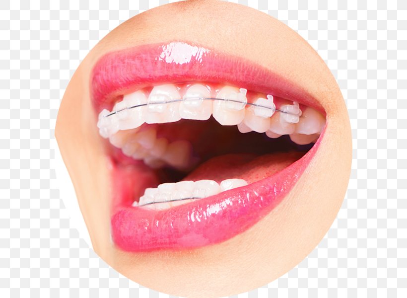 Byfleet Dental Boutique Orthodontics Dentistry Dental Braces, PNG, 600x600px, Orthodontics, Clear Aligners, Cosmetic Dentistry, Dental Braces, Dental Implant Download Free