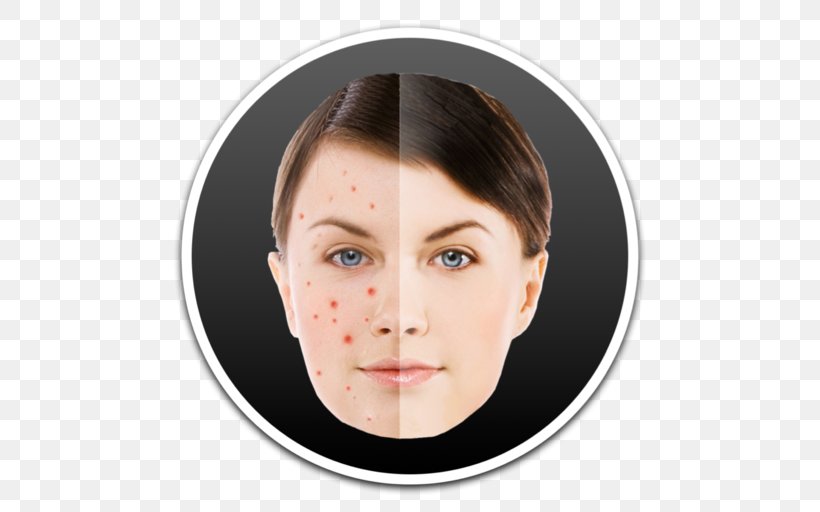 Pimple Acne Intense Pulsed Light, PNG, 512x512px, Pimple, Acne, Apple, Cheek, Chin Download Free