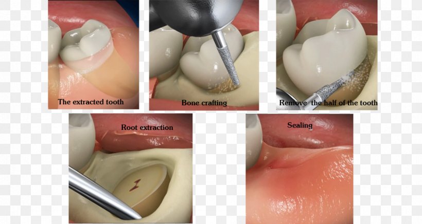 Wisdom Tooth Dental Surgery Dentistry, PNG, 940x500px, Wisdom Tooth, Anesthesia, Bone Fracture, Chin, Dental Surgery Download Free