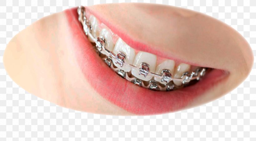 Orthodontics Dental Braces Dentistry, PNG, 936x515px, Orthodontics, Chin, Clear Aligners, Dental Braces, Dental Surgery Download Free