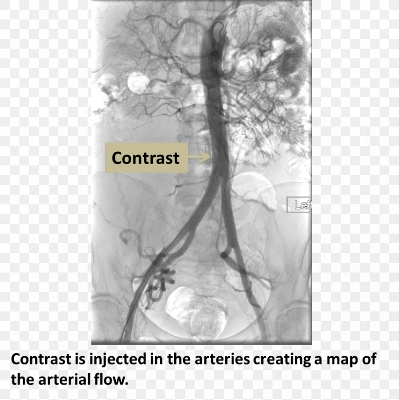 Computed Tomography Angiography Femoral Artery Coronary Catheterization Medical Procedure, PNG, 875x878px, Angiography, Angioplasty, Artery, Black And White, Catheter Download Free