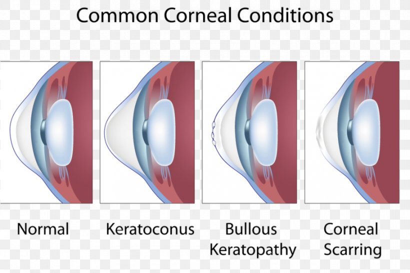 Keratoconus Corneal Limbus Eye Symptom, PNG, 911x608px, Keratoconus, Conjunctiva, Contact Lenses, Cornea, Corneal Limbus Download Free