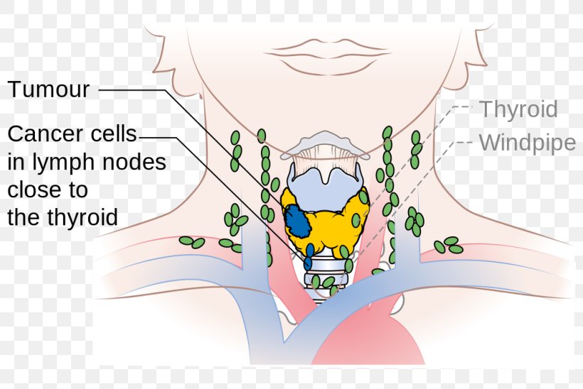 Cervical Lymph Nodes Thyroid Cancer Paratracheal Lymph Nodes, PNG, 800x548px, Watercolor, Cartoon, Flower, Frame, Heart Download Free