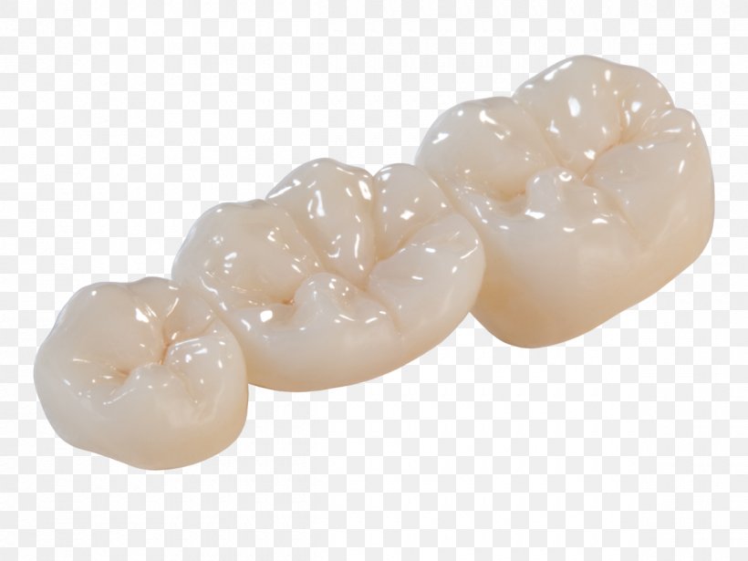 Crown Bridge Zirconium Dioxide Dentistry Dental Laboratory, PNG, 1200x900px, Crown, Bridge, Ceramic, Dental Implant, Dental Laboratory Download Free