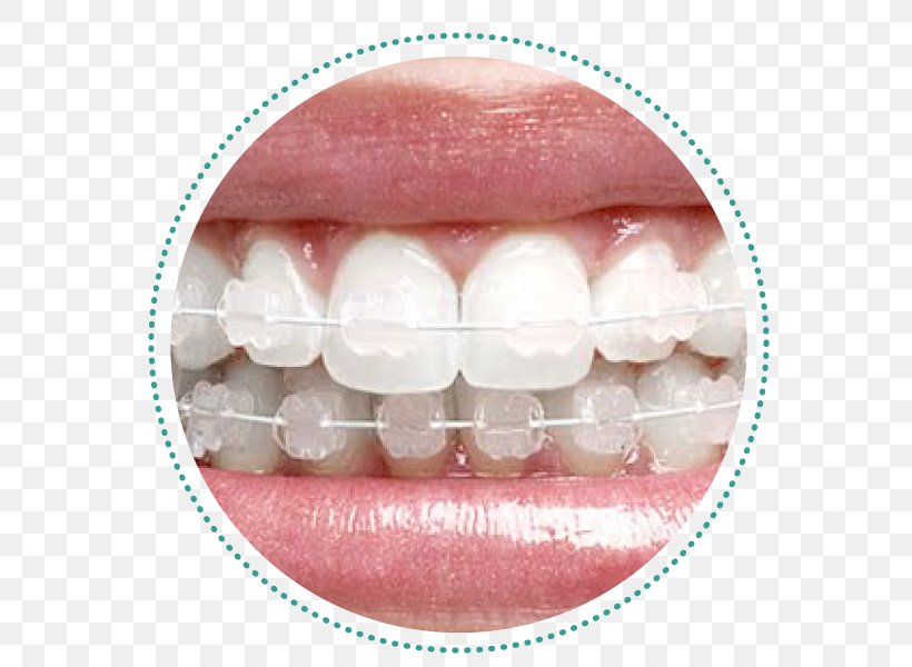 Dental Braces Orthodontics Dentistry Tratamento, PNG, 600x600px, Dental Braces, Clinica, Cosmetic Dentistry, Dental Implant, Dentist Download Free