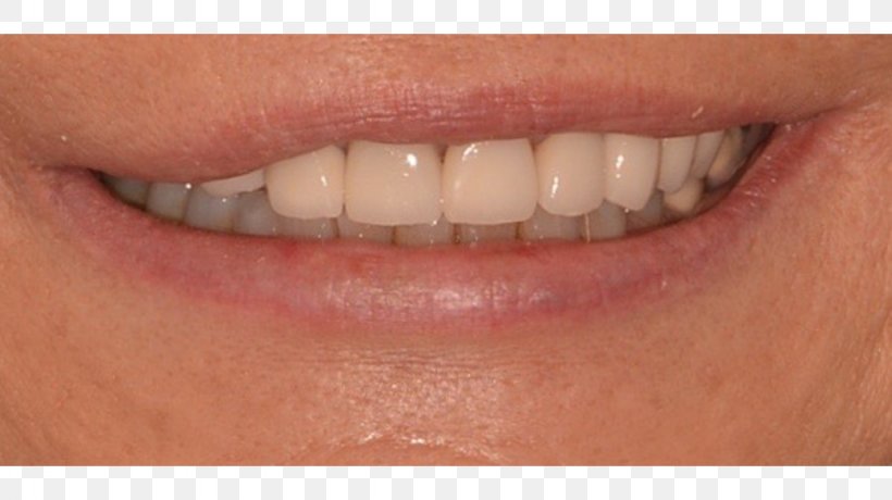 Dr. Francesco P. Maratta, PNG, 1024x575px, Tooth, Ceramic, Cheek, Chin, Close Up Download Free