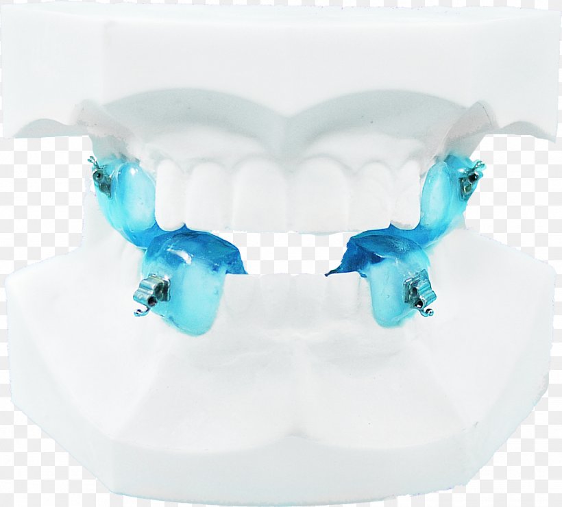 Jaw Orthodontics Dental Braces Twin Block Appliance Therapy, PNG, 1421x1284px, Jaw, Aqua, Blue, Body Jewelry, Clinic Download Free