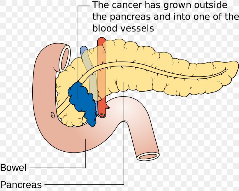 Pancreatic Cancer Pancreas Disease Death, PNG, 2000x1598px, Watercolor, Cartoon, Flower, Frame, Heart Download Free